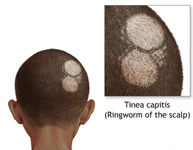 ringworm of the scalp